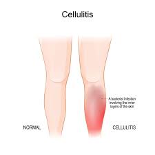 Cellulitis: Understanding, Managing, and Preventing a Common Skin Infection cellulitis